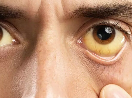 کبد چرب درجه 2