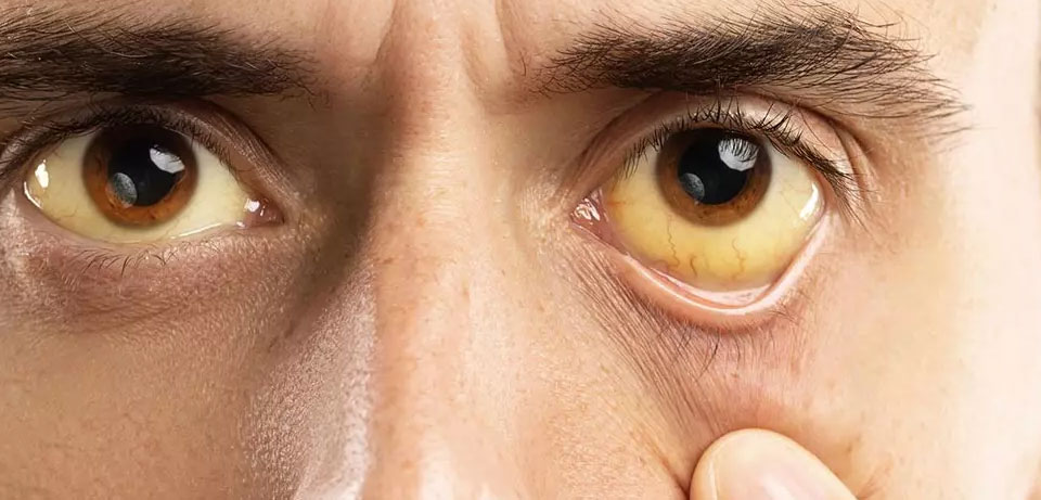 کبد چرب درجه 2